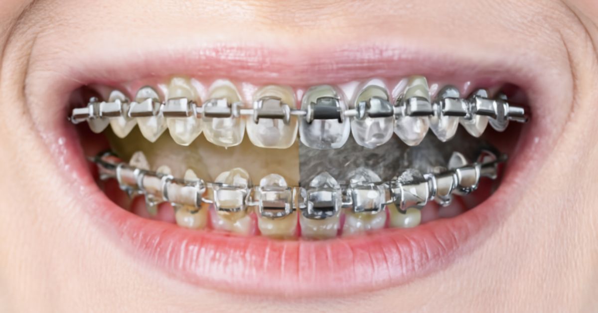 How Does Invisalign Work Compared to Traditional Braces? A Comprehensive Guide