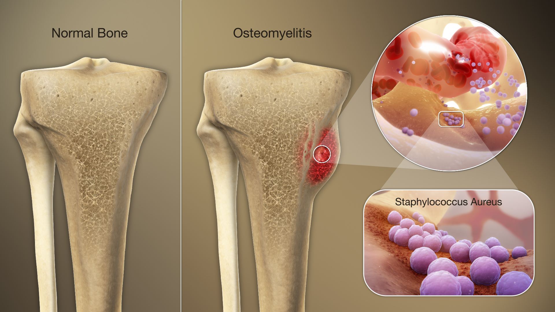 How Skin Infections Can Lead to Bone Infection