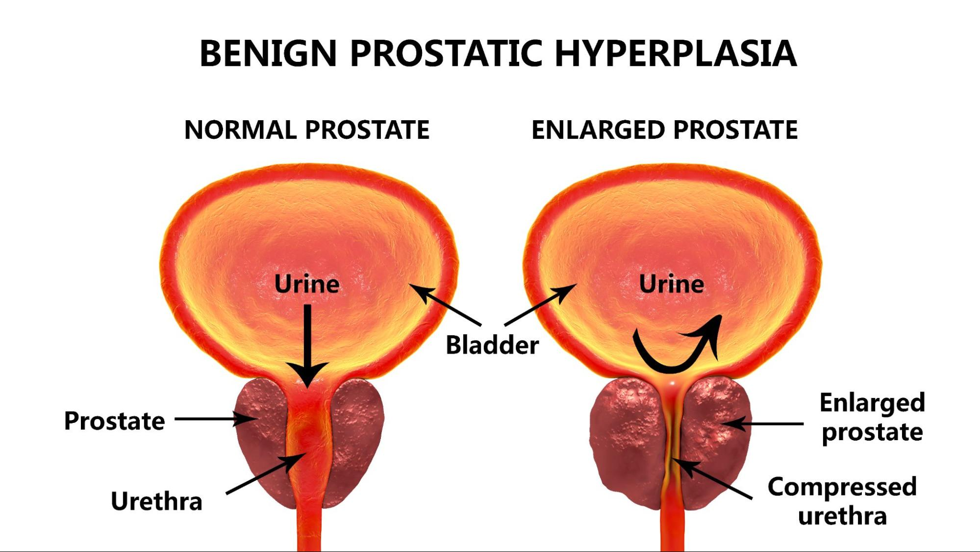 How an Enlarged Prostate Affects Your Daily Life