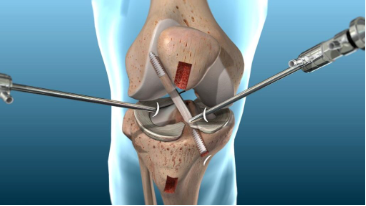 What to Expect During ACL Repair Surgery and Recovery