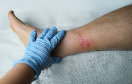 Tips to Improve Wound Care and Healing