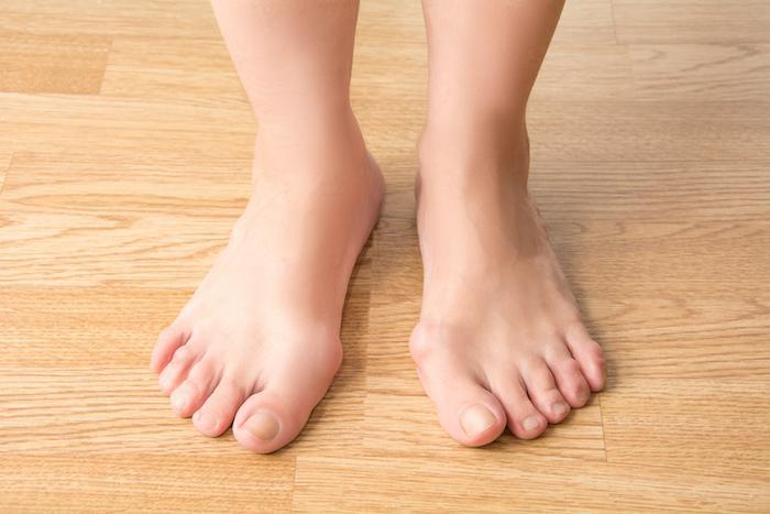 How Bunions Impact Your Daily Life and What You Can Do About Them