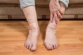 What You Should Know About the Early Signs of Foot Deformities