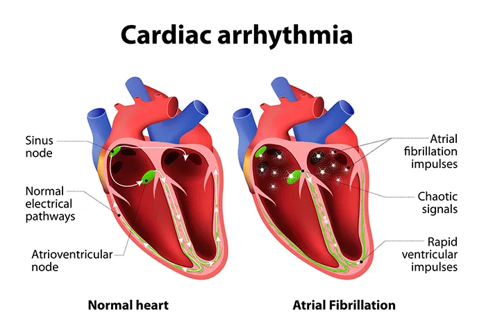 Understanding Heart Palpitations and Their Causes