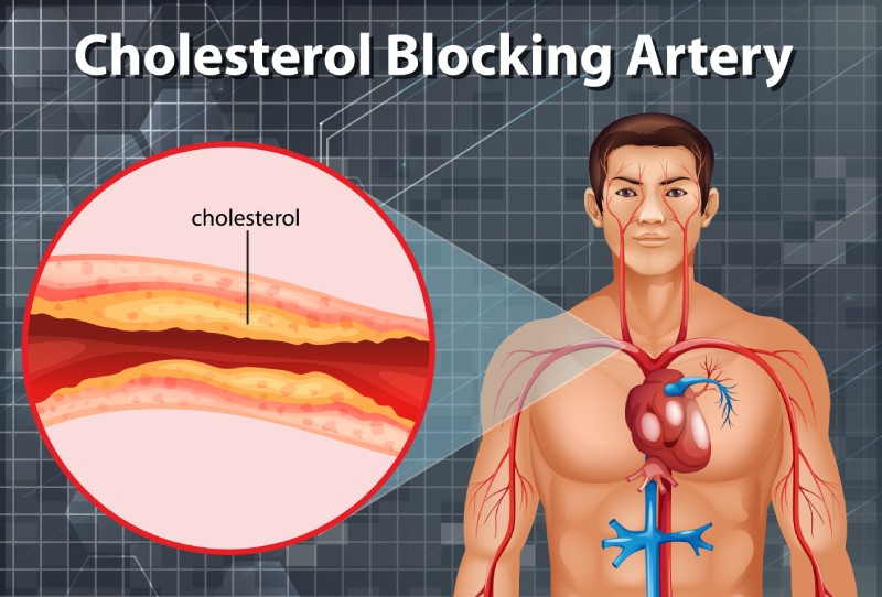 Understanding How High Cholesterol Contributes to Heart Disease and How to Manage It