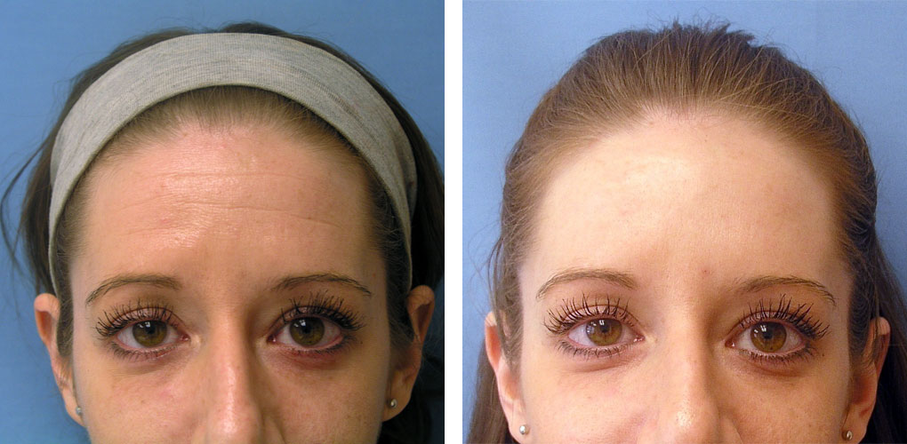 How Botox® Can Help Smooth Wrinkles and Fine Lines