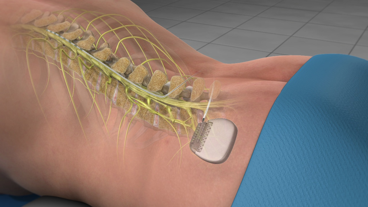 Spinal Cord Stimulators: How They Work for Pain Control