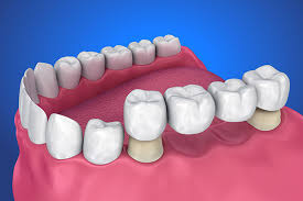 The Long-Term Benefits of Choosing Dental Implants for Missing Teeth