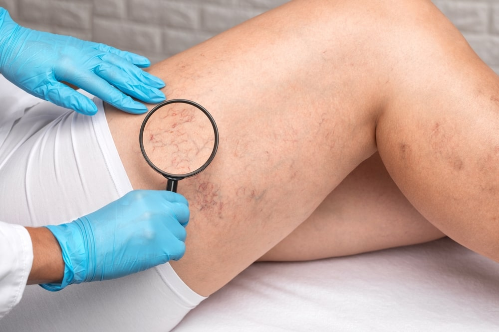 Top Treatments for Spider Veins: From Sclerotherapy to Laser Therapy