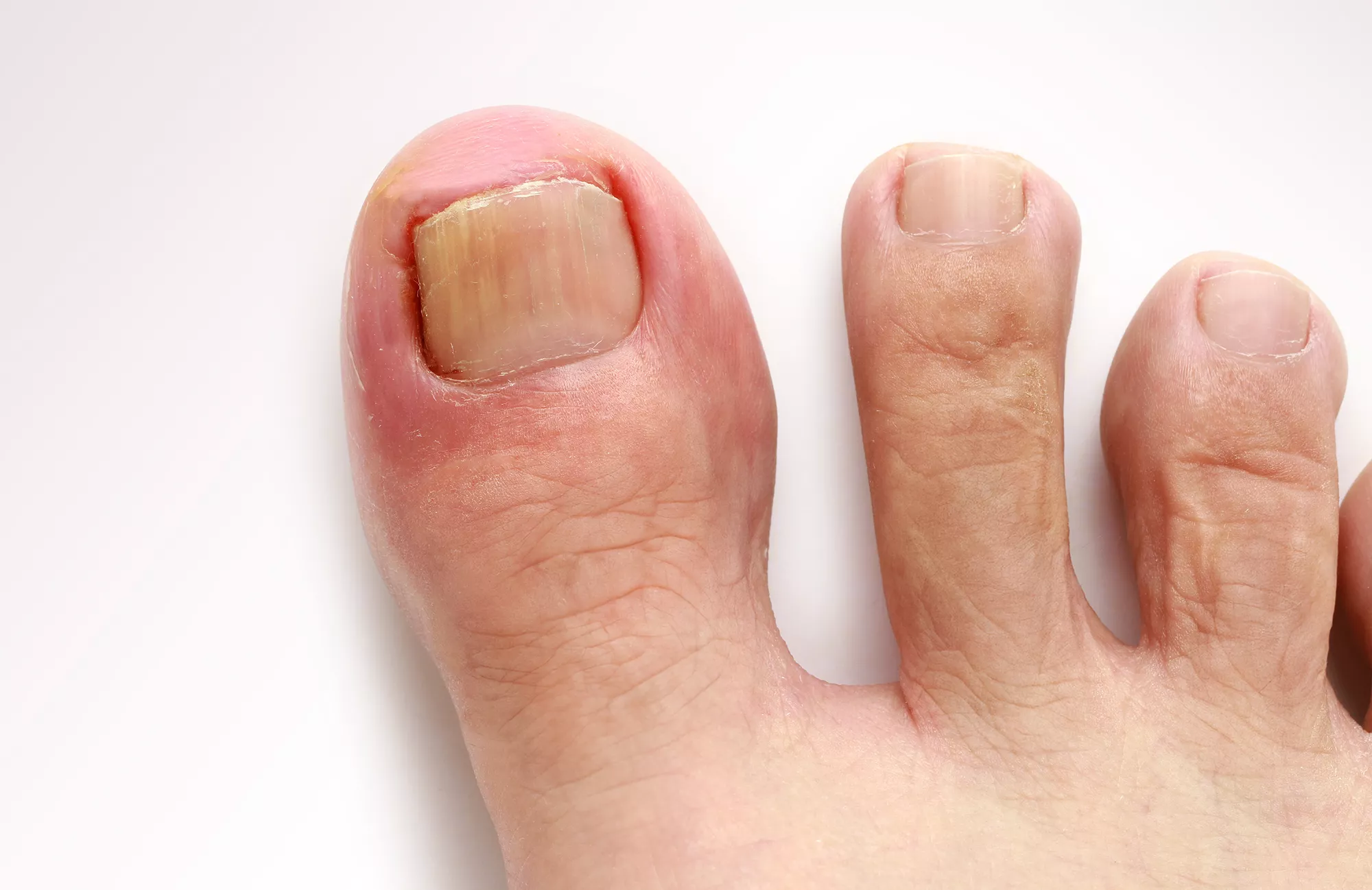 Ingrown Toenail Treatment: How to Manage Pain and Prevent Recurrence